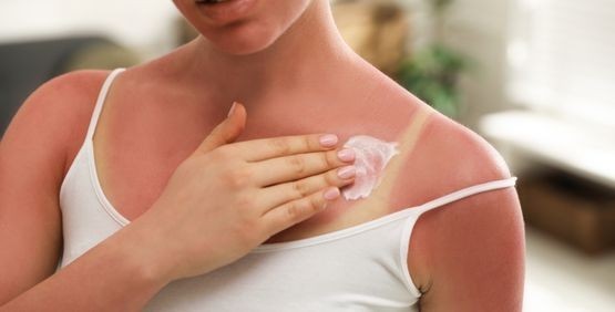 Come riconoscere e curare l’eritema solare