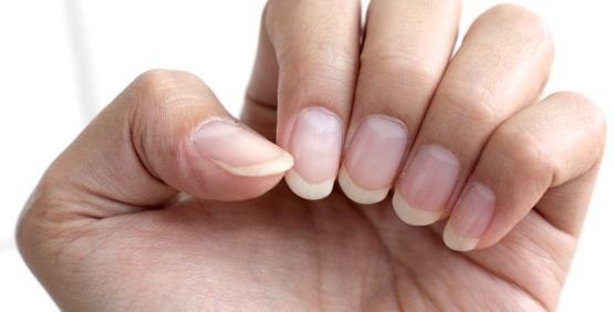 Come curare la micosi delle unghie