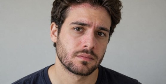 Cos'è la dermatite seborroica e come si tratta Cos'è la dermatite seborroica e come si tratta