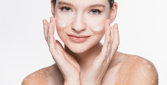 Vitiligine: i falsi miti da sfatare