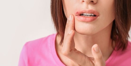 Herpes labiale: cause, sintomi e rimedi